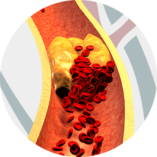 zbeidi-doencas-vasculares-aterosclerose