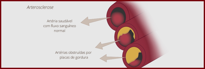 Arteriosclerose Imagem Arteriosclerose