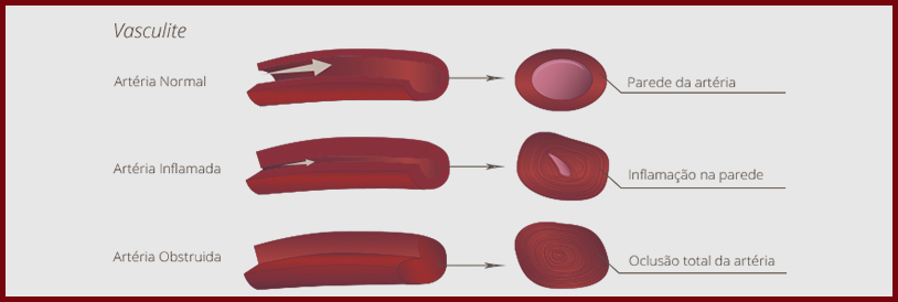 Vasculites Imagem Vasculites