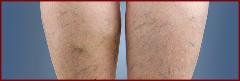 Escleroterapia Imagem Escleroterapia