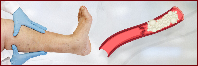 Escleroterapia de Espuma Imagem Escleroterapia de Espuma