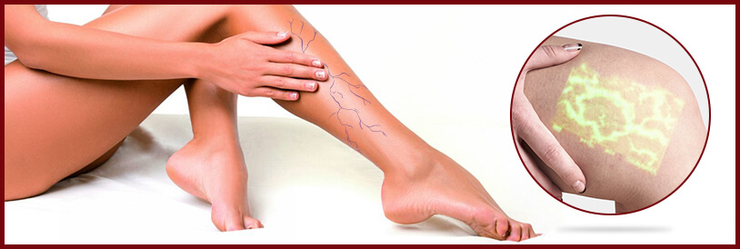 Escleroterapia Ampliada Imagem Escleroterapia Ampliada