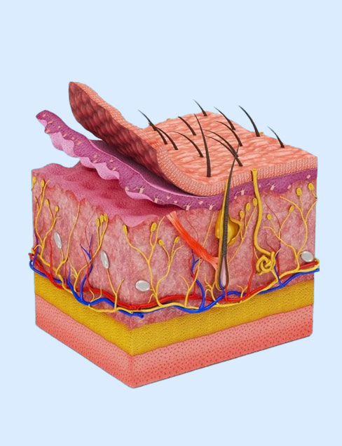Descolamento Subcutâneo